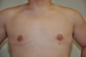 Patient 4 - Mastectomy and Liposuction After Front