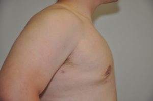 Patient 4 - Mastectomy and Liposuction After Side