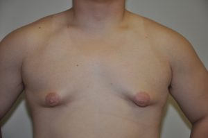 Patient 4 - Mastectomy and Liposuction Before Front