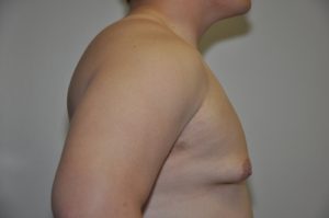Patient 4 - Mastectomy and Liposuction Before Side