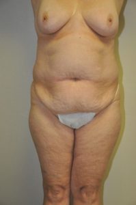 Patient 4 - Tummy Tuck Before