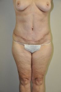 Patient 4 - Tummy Tuck After