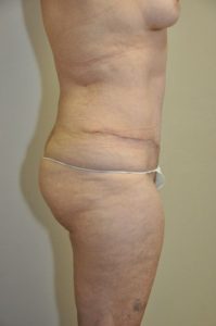 Patient 4 - Tummy Tuck After