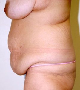 Patient 4 - Tummy Tuck Following Large Weight Loss Before