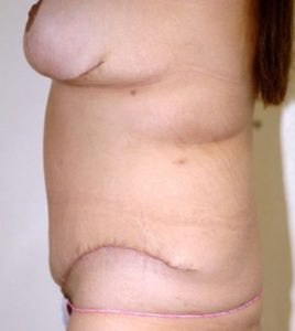 Patient 4 - Tummy Tuck Following Large Weight Loss After