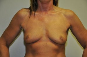 Patient 5 - Breast Augmentation with Implants Before