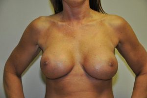 Patient 5 - Breast Augmentation with Implants After