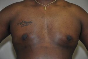 Patient 5 - Mastectomy and Liposuction After Front