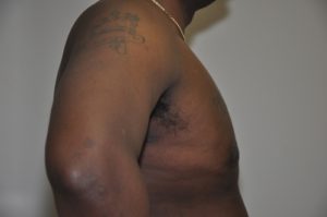 Patient 5 - Mastectomy and Liposuction After Side