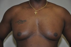 Patient 5 - Mastectomy and Liposuction Before Front