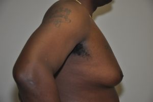Patient 5 - Mastectomy and Liposuction Before Side