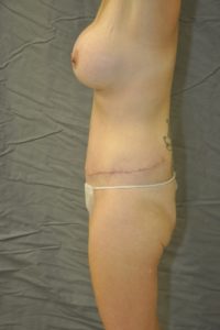 Patient 5 - Tummy Tuck After
