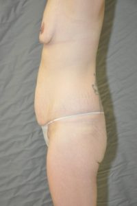 Patient 5 - Tummy Tuck Before