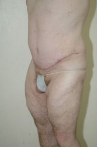 Patient 5 - Tummy Tuck Following Large Weight Loss After