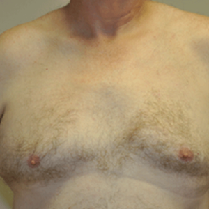 Patient 6 - Breast Reduction Before