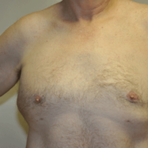 Patient 6 - Breast Reduction After