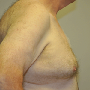 Patient 6 - Breast Reduction Before