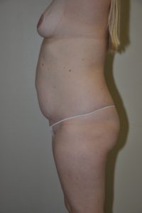 Patient 6 -Tummy Tuck Before