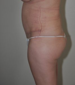 Patient 7 - Tummy Tuck After