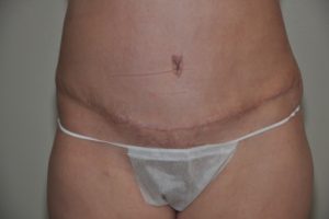 Patient 7 - Tummy Tuck After