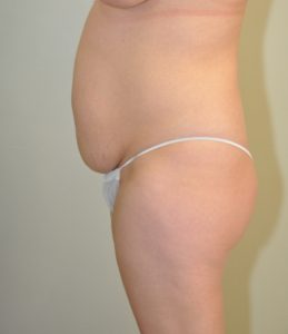 Patient 7 - Tummy Tuck Before