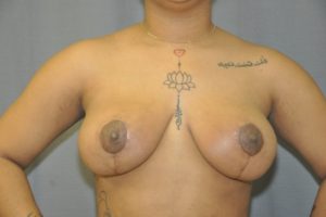 Patient 8 - Breast Reduction After