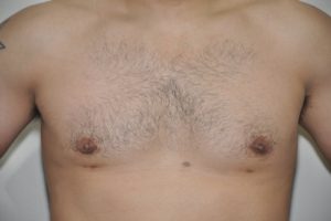 Patient 8 - Breast Reduction After