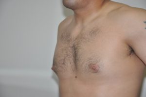 Patient 8 - Breast Reduction Before
