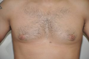 Patient 8 - Breast Reduction Before