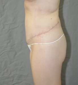 Patient 8 - Tummy Tuck After