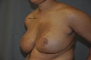 Patient 9 - Breast Reduction After