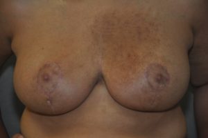 Patient 9 - Breast Reduction After