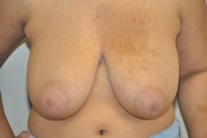 Patient 9 - Breast Reduction Before