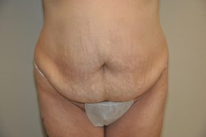 Patient 9 - Tummy Tuck Before