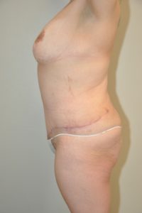 Patient 9 - Tummy Tuck After