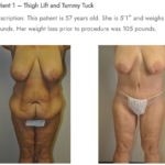 Thigh Lift - Image 3
