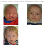 Pediatric Cleft Lip and Palate - Image 4