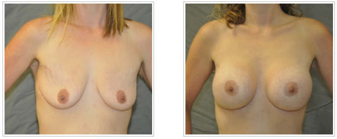 Dr. Jack Peterson's breast augmentation: before and after transformations through plastic surgery.