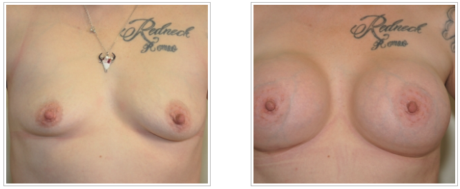 Before and after pictures of a woman's breast surgery performed by Dr. Jack Peterson in the field of Plastic Surgery.