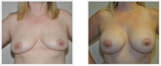 Before and after pictures of breast surgery performed by Dr. Jack Peterson, a plastic surgeon.