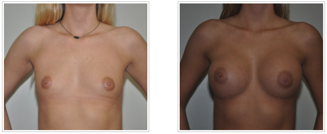 Before and after breast augmentation showcasing the transformation performed by Dr. Jack Peterson, a plastic surgeon.