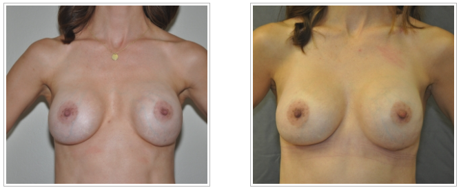 A woman's breast before and after plastic surgery performed by Dr. Jack Peterson.