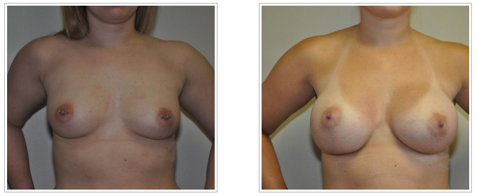 A woman's breast transformation through plastic surgery performed by Dr. Jack Peterson.
