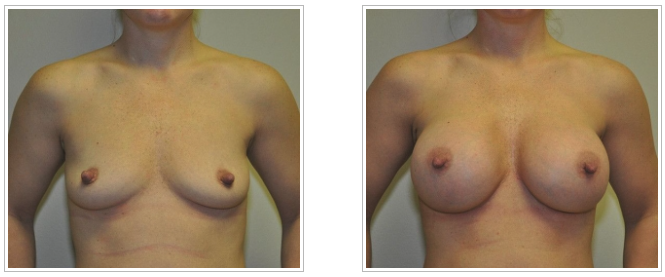 A woman's breasts before and after undergoing breast augmentation by Dr. Jack Peterson, a plastic surgeon.