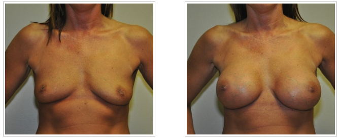 Before and after breast augmentation performed by Dr. Jack Peterson, a leading plastic surgeon.