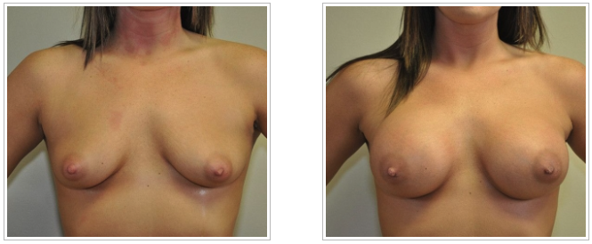 Dr. Jack Peterson performs breast augmentation, showcasing the before and after results of a woman's breasts.
