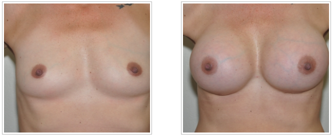 A woman's breasts transformed with breast augmentation by Dr. Jack Peterson, a renowned plastic surgeon.