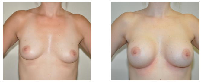 Plastic surgery: Dr. Jack Peterson's transformative procedure enhances a woman's breast appearance.