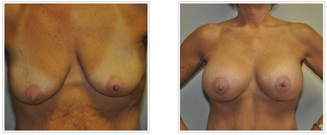 Before and after pictures of breast augmentation by Dr. Jack Peterson.