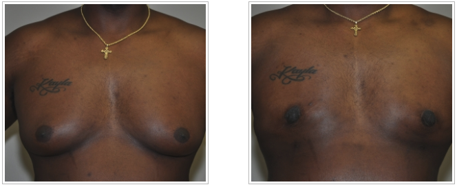 Breast Reduction Patient 5